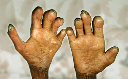 Nigeria's Leprosy Crisis: 2,425 New Cases in 2023 with 10% Grade 2 Disability Rate